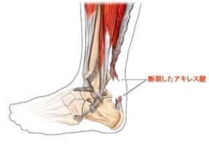 破裂音がする？！アキレス腱断裂とは？
